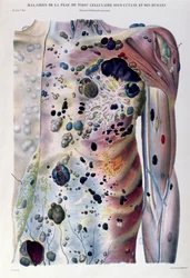 Guzy i guzki rakowe, z „Anatomie Pathologique du Corps Humain” Jeana Cruveilhiera (1791-1874) 1828-42